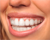ProSnore ADJUSTABLE ORAL APPLIANCE